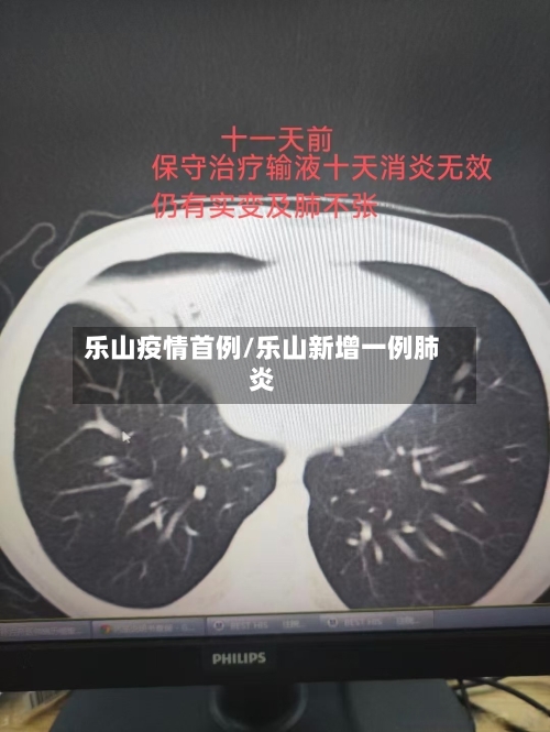 乐山疫情首例/乐山新增一例肺炎-第3张图片